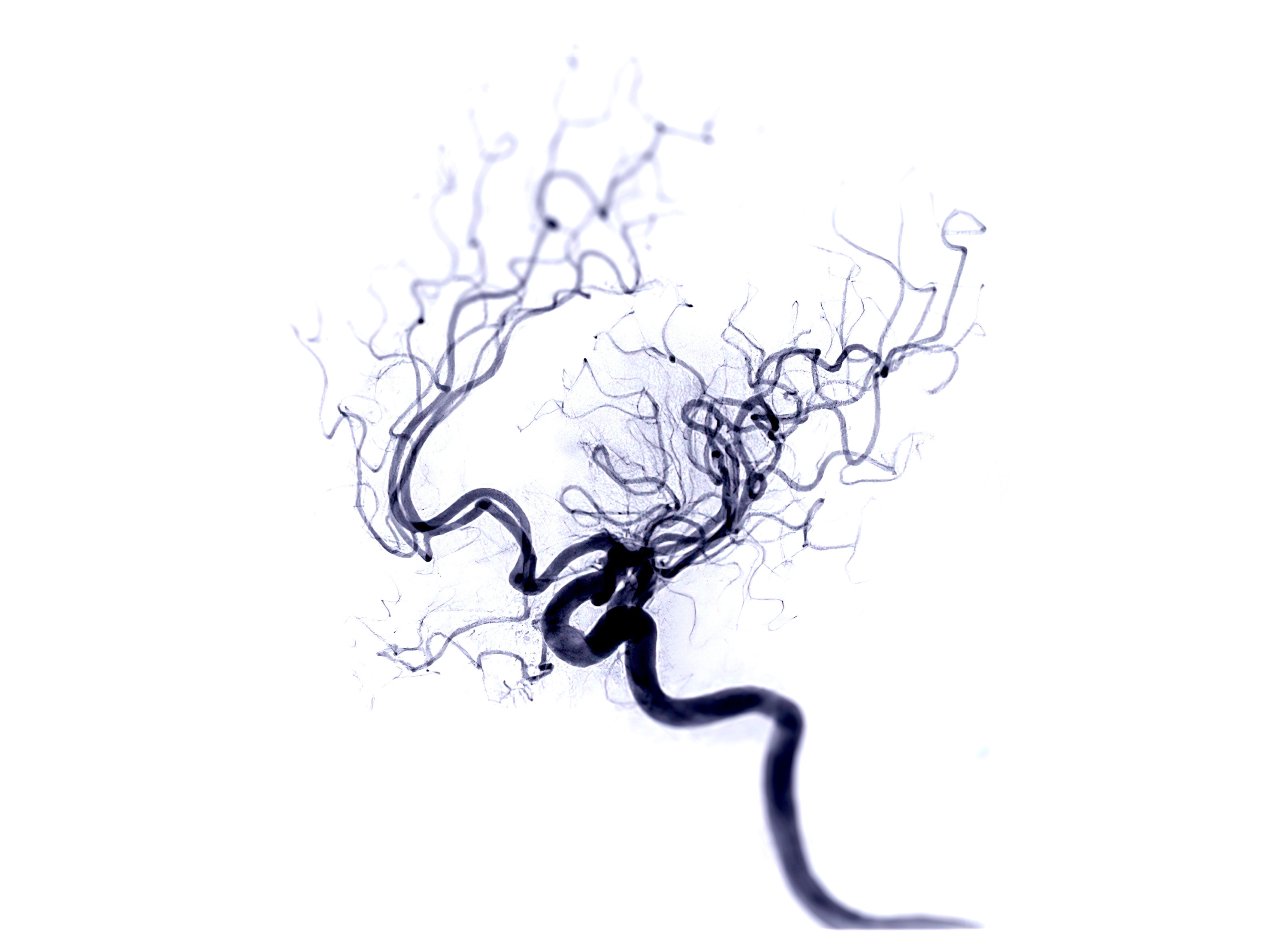 BZgA Organspende Blog Sicher Diagnose Hirntod 1 Zu sehen ist die MRT-Aufnahme eines Blutgefäßes.